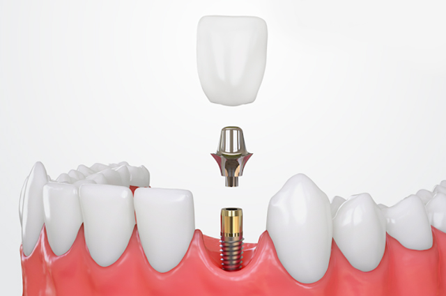 Implantes-Dentários-banner